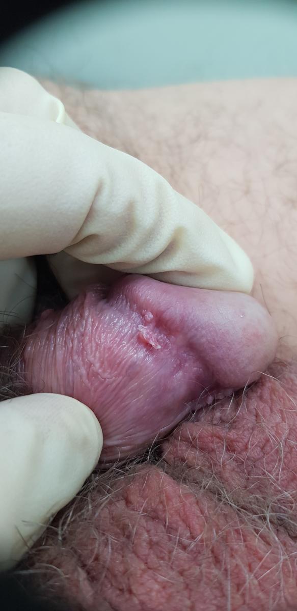 Остроконечные кондиломы на члене