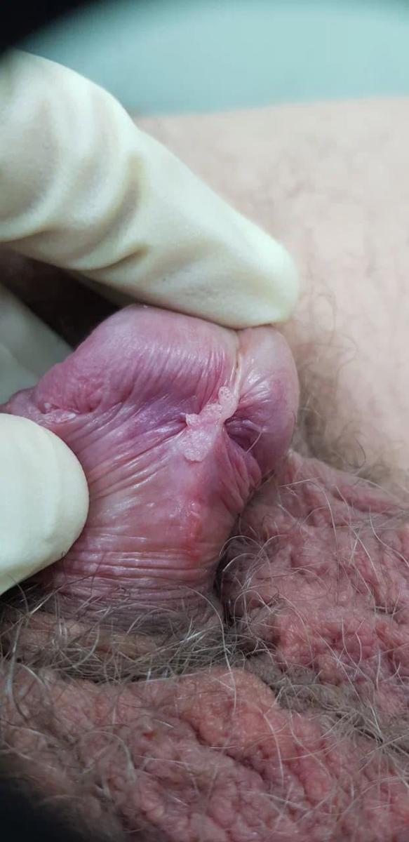 кондиломы при впч на половом члене