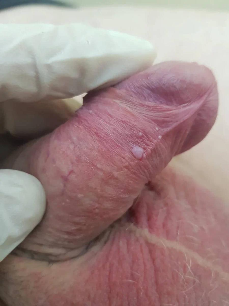 удаление кандилом