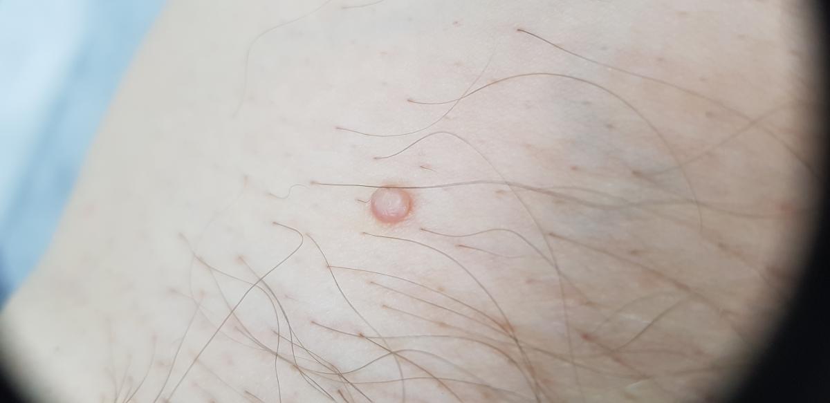 Моллюск в паху