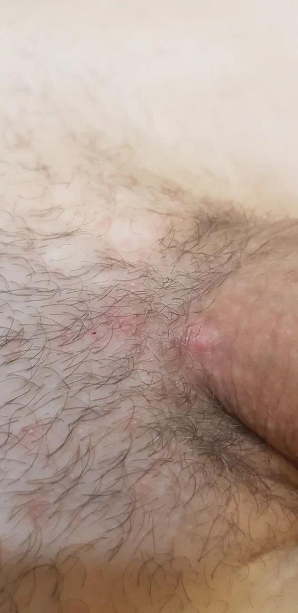 вросший волос нарывает