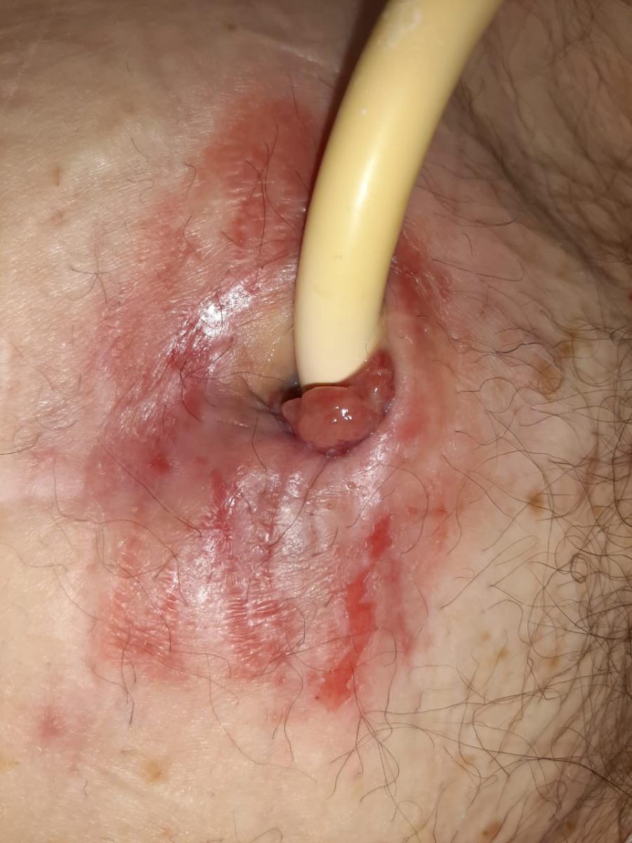 установка цистостомы эпицистостома