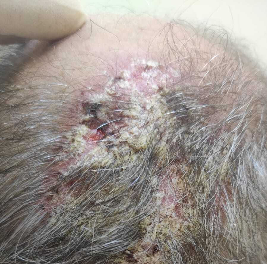 Корки на голове Корки на голове при сифилисе