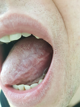 фото сыпи на языке после кунилингуса