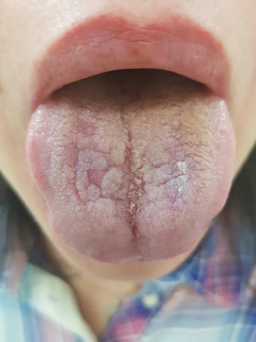 Сифилиды во рту Сифилиды на языке