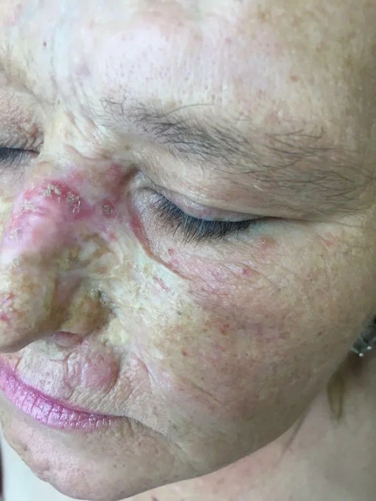 красная волчанка