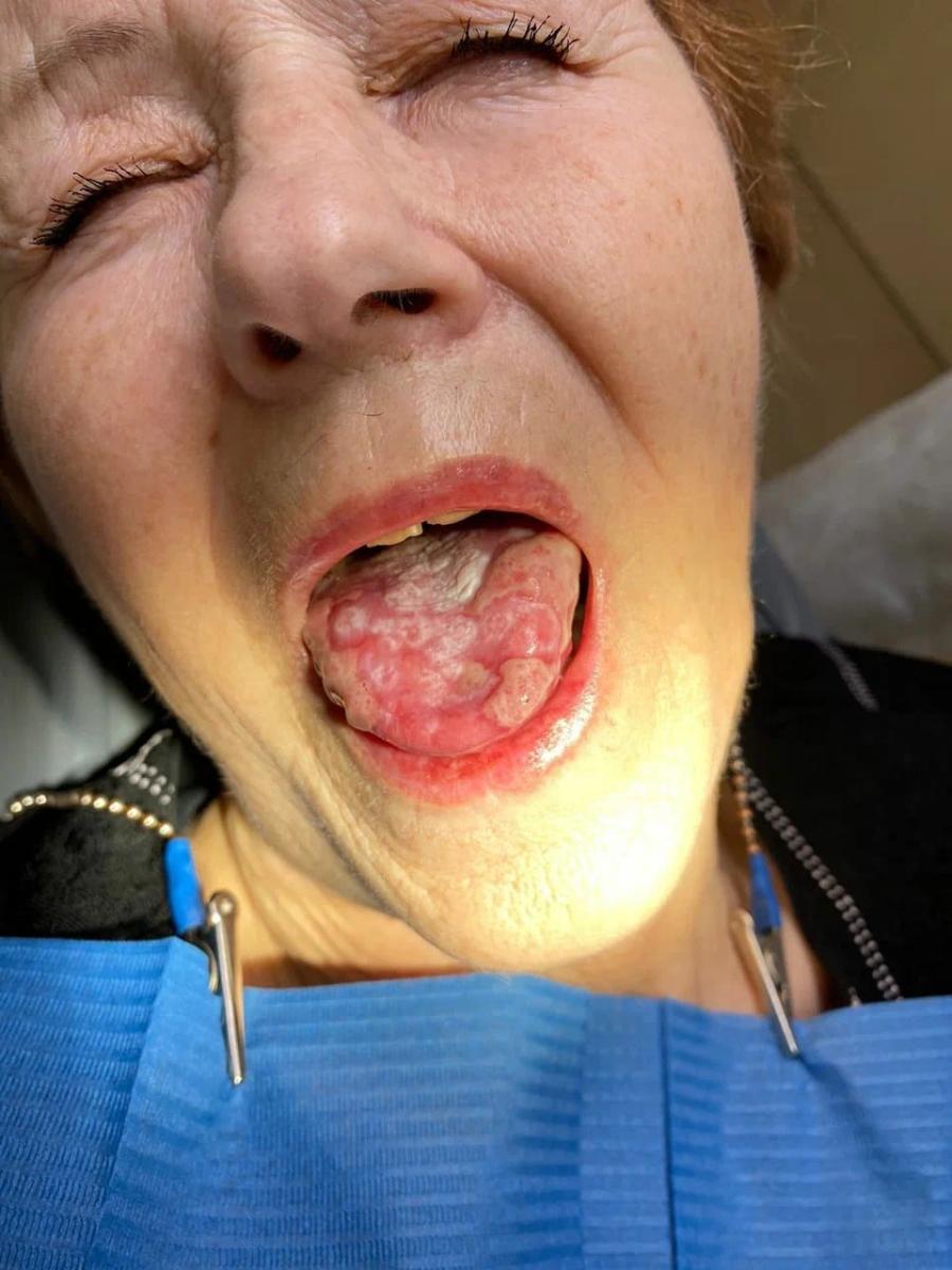 лишай языка лишай языка