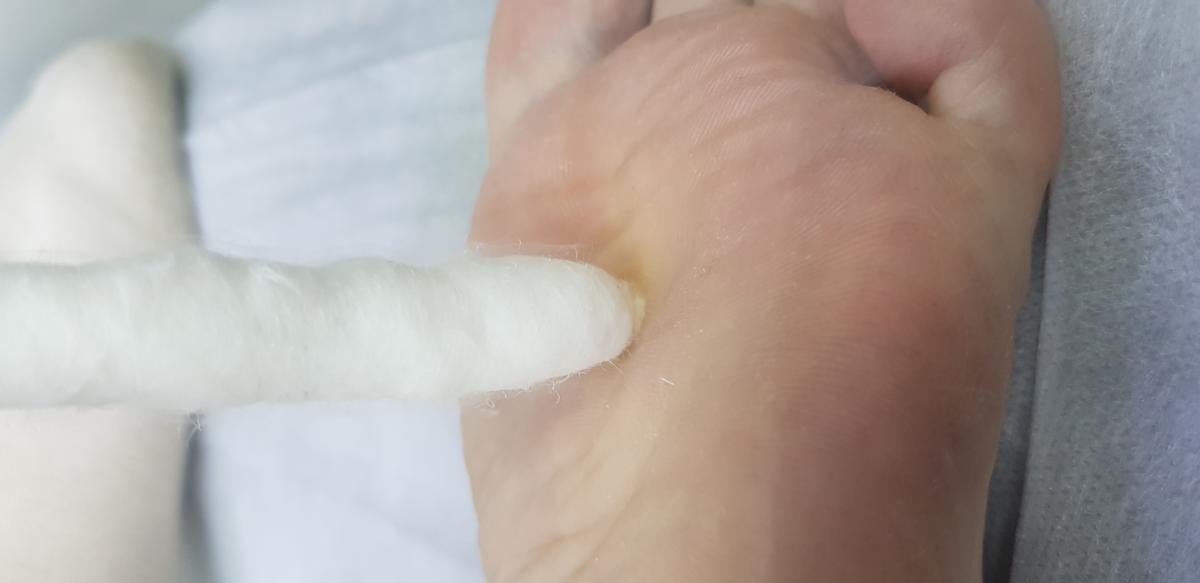 удаление азотом бородавки