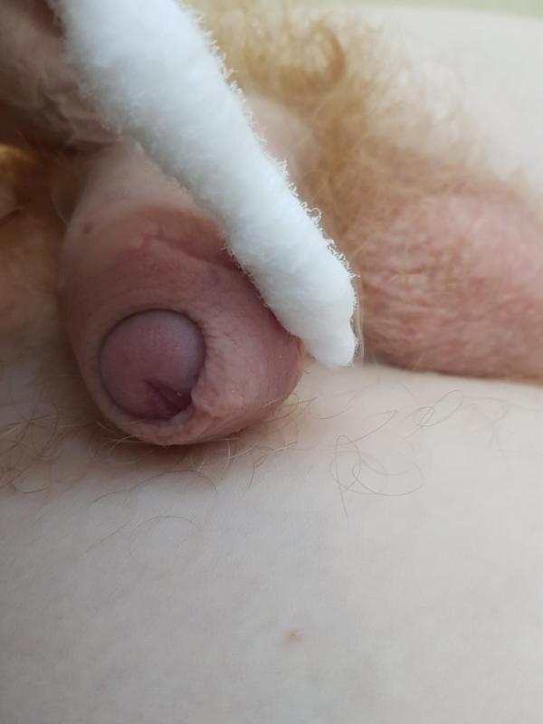 криотерапия