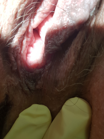 герпес у нижней спайки половых губ после 14 дней с презервативом, болезненность от мочи