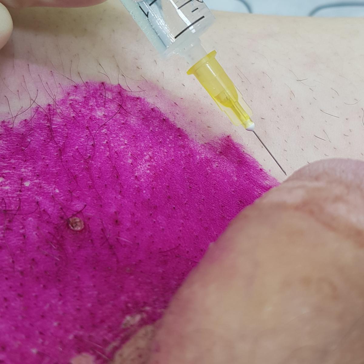 Лимфотропное введение антибиотиков Лимфотропное введение антибиотиков