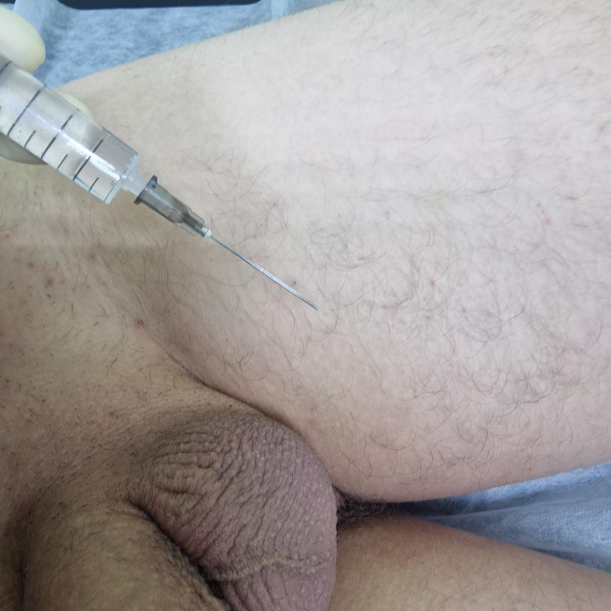 Лимфотропное введение лекарственных препаратов Лимфотропная инъекция