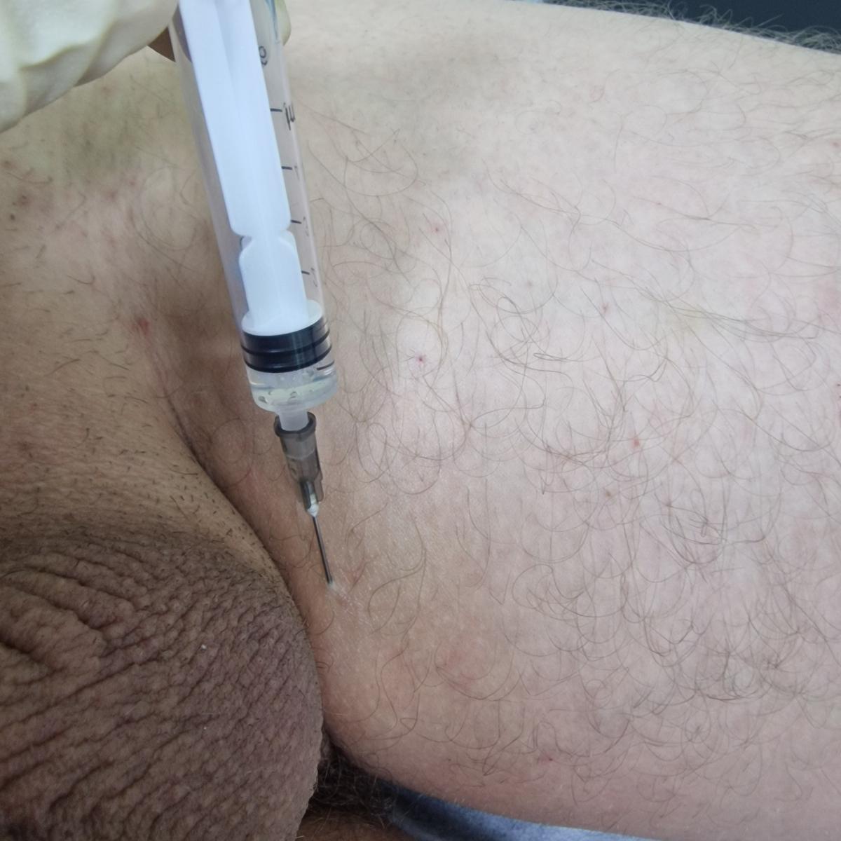 лечение сифилиса сифилис: лечение антибиотиками