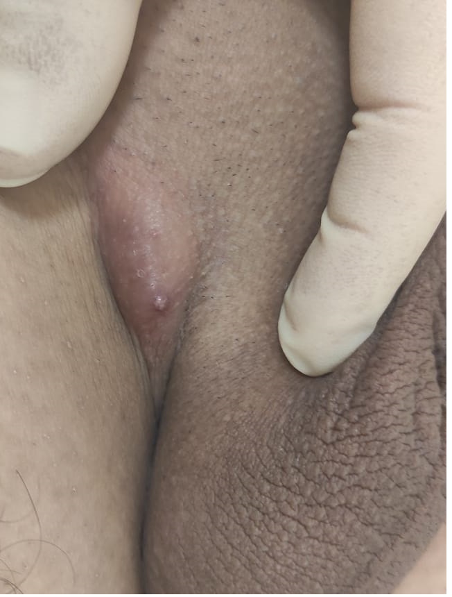 увеличение лимфоузла