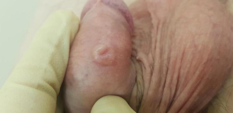 вздутие полового члена