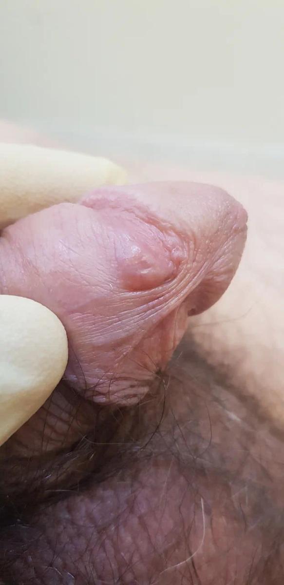 воспаление лимфатических сосудов полового члена