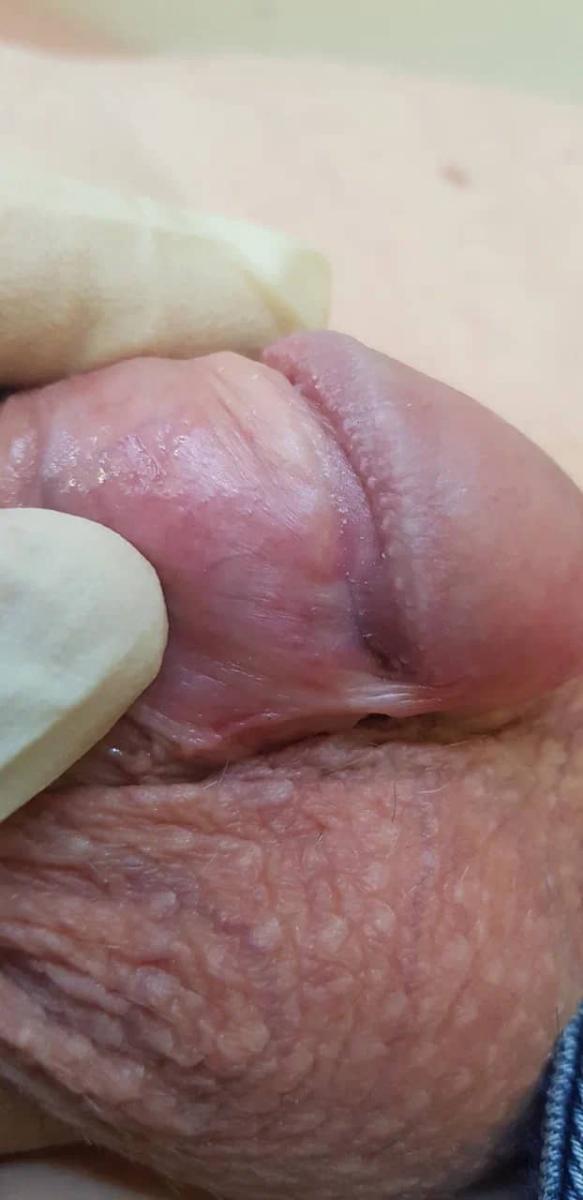 лимфатический сосуд около уретры2