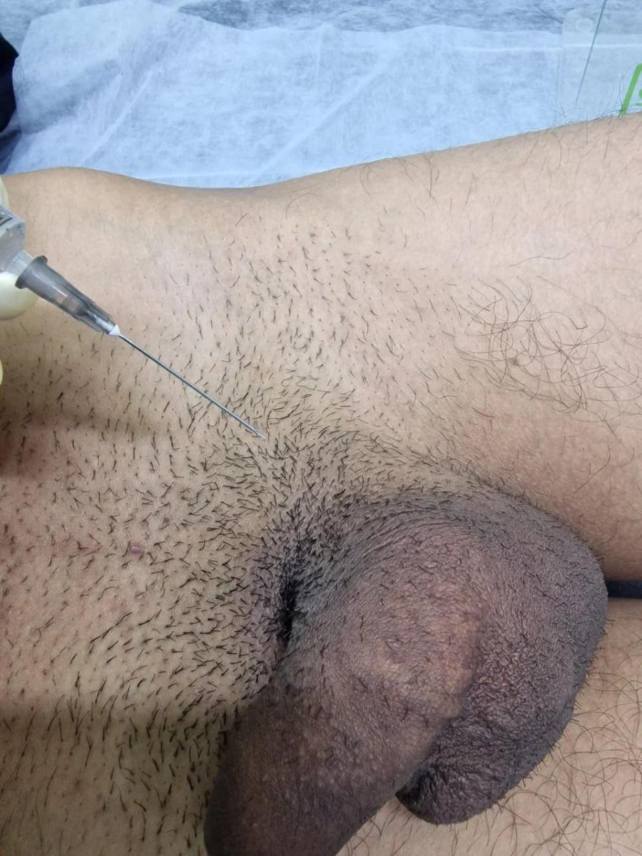 Лимфотропное введение антибиотиков
