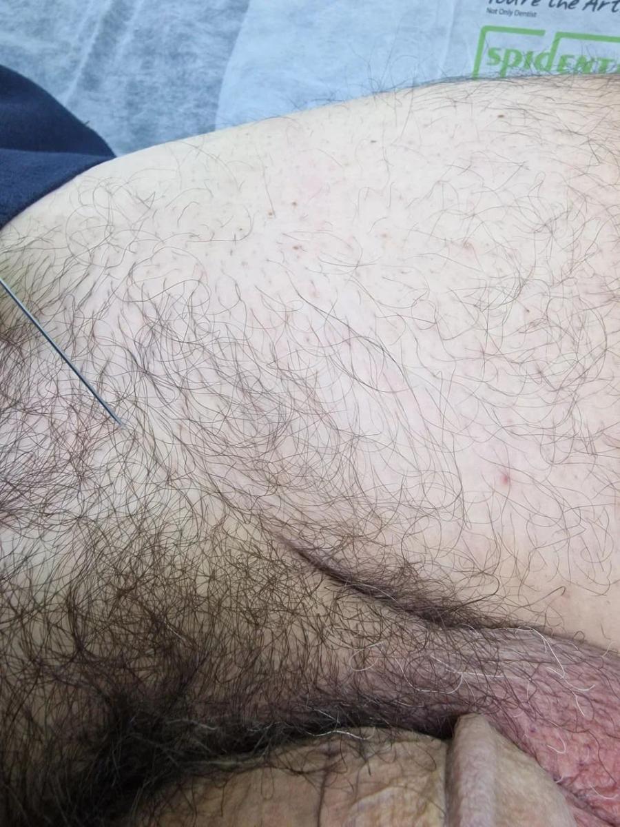 Лимфотропное введение