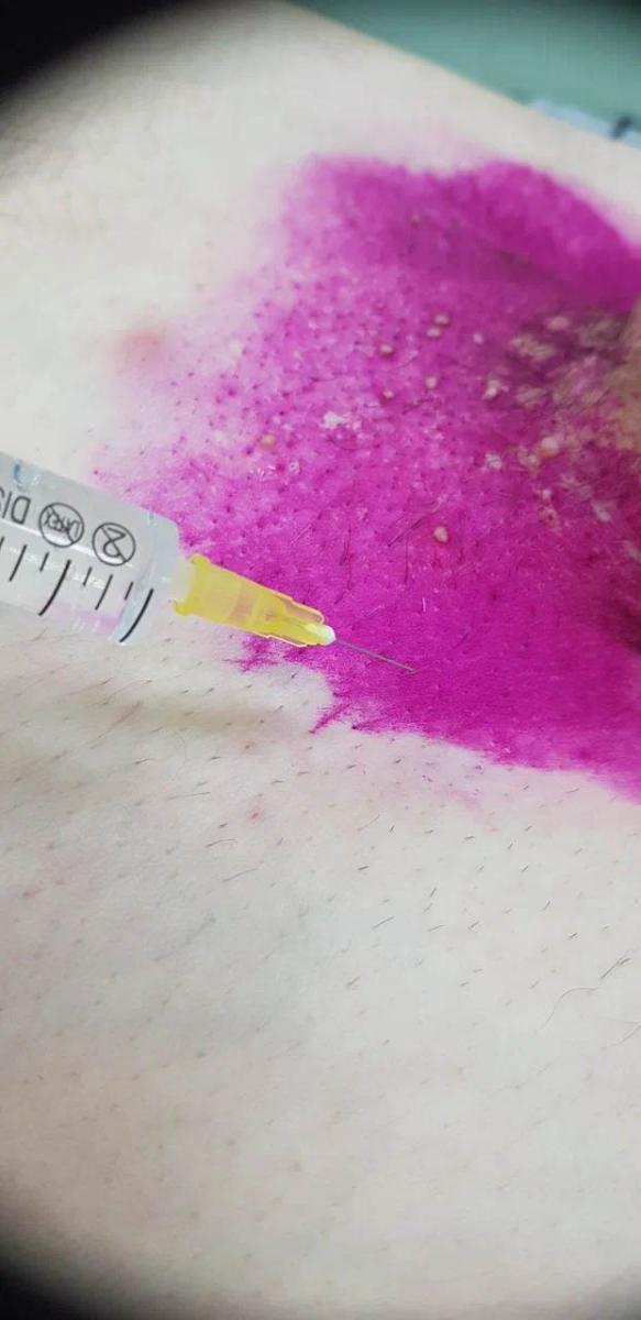 лимфотропное введение лимфотропное введение