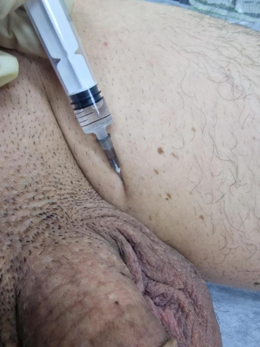 Лимфотропное введение