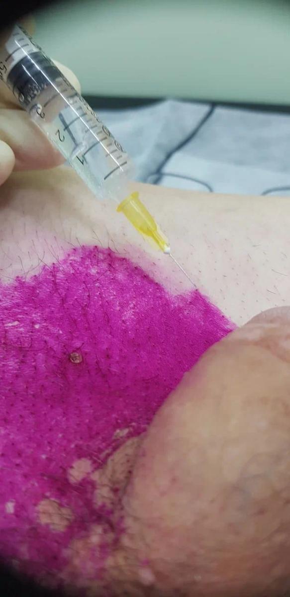 Лимфотропное введение