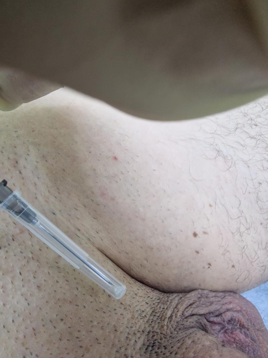 лимфотропная терапия