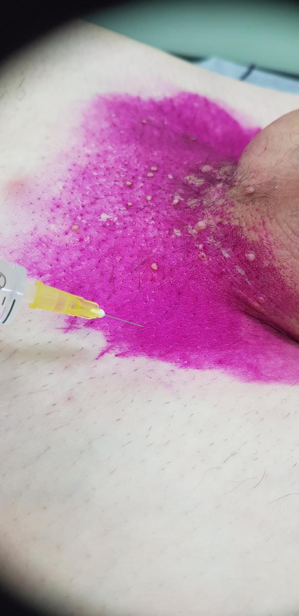 лимфотропная терапия лимфотропка