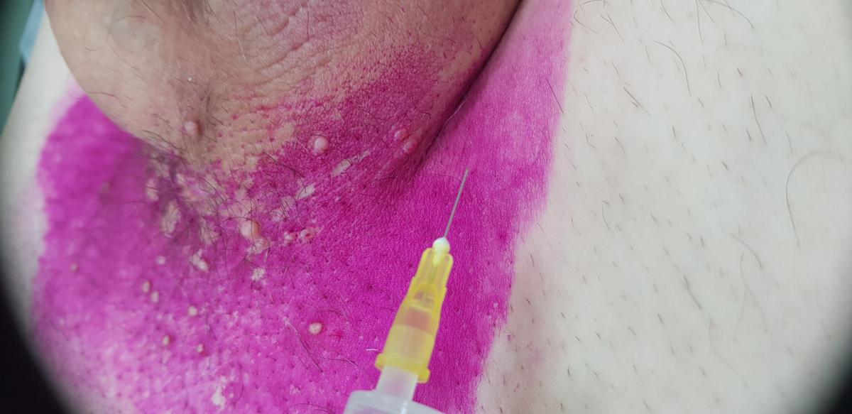 лимфотропная терапия лимфотропка