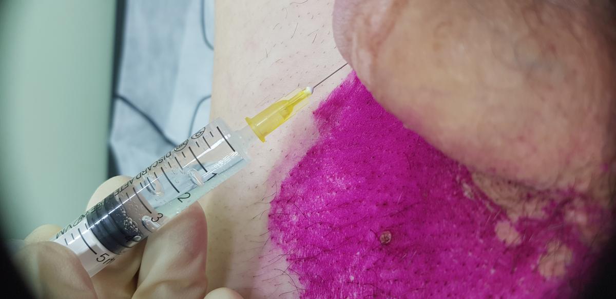 Внутривенное и лимфотропное введение антибиотиков лимфотропная терапия