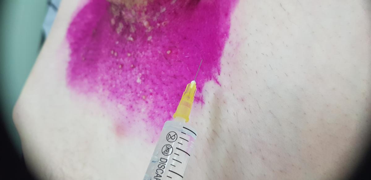 лимфотропная терапия