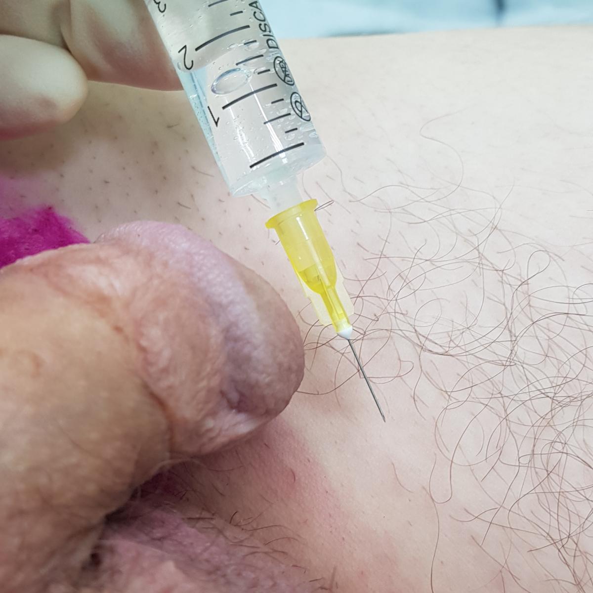 лимфотропная инъекция лимфотропная инъекция