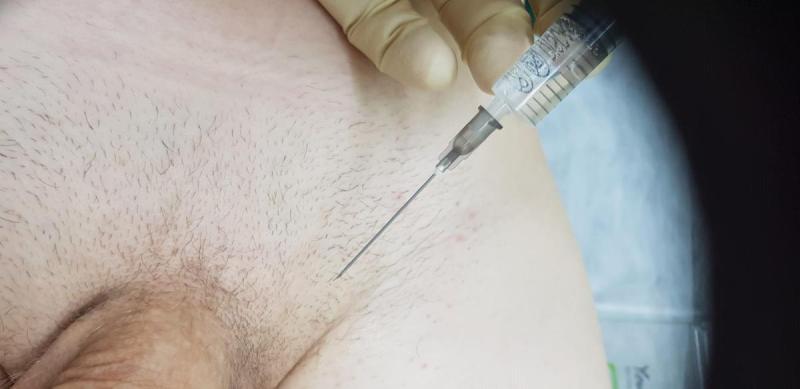 лечение варикоза полового члена