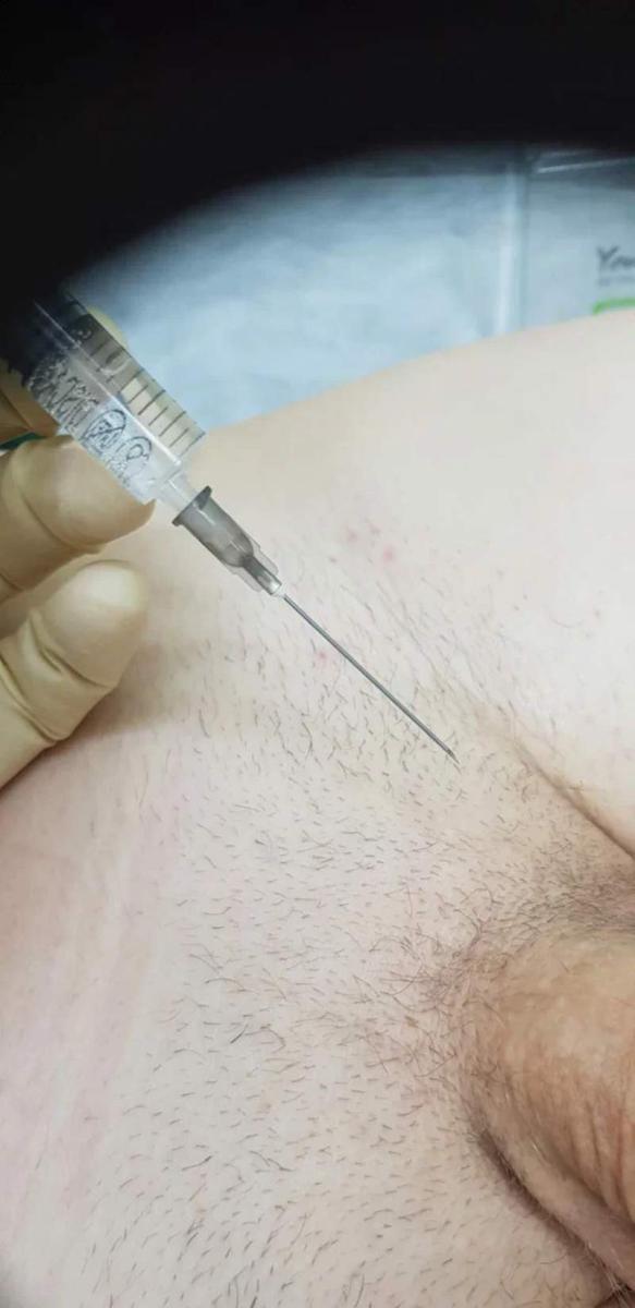 Лимфотропное введение Лимфотропное введение