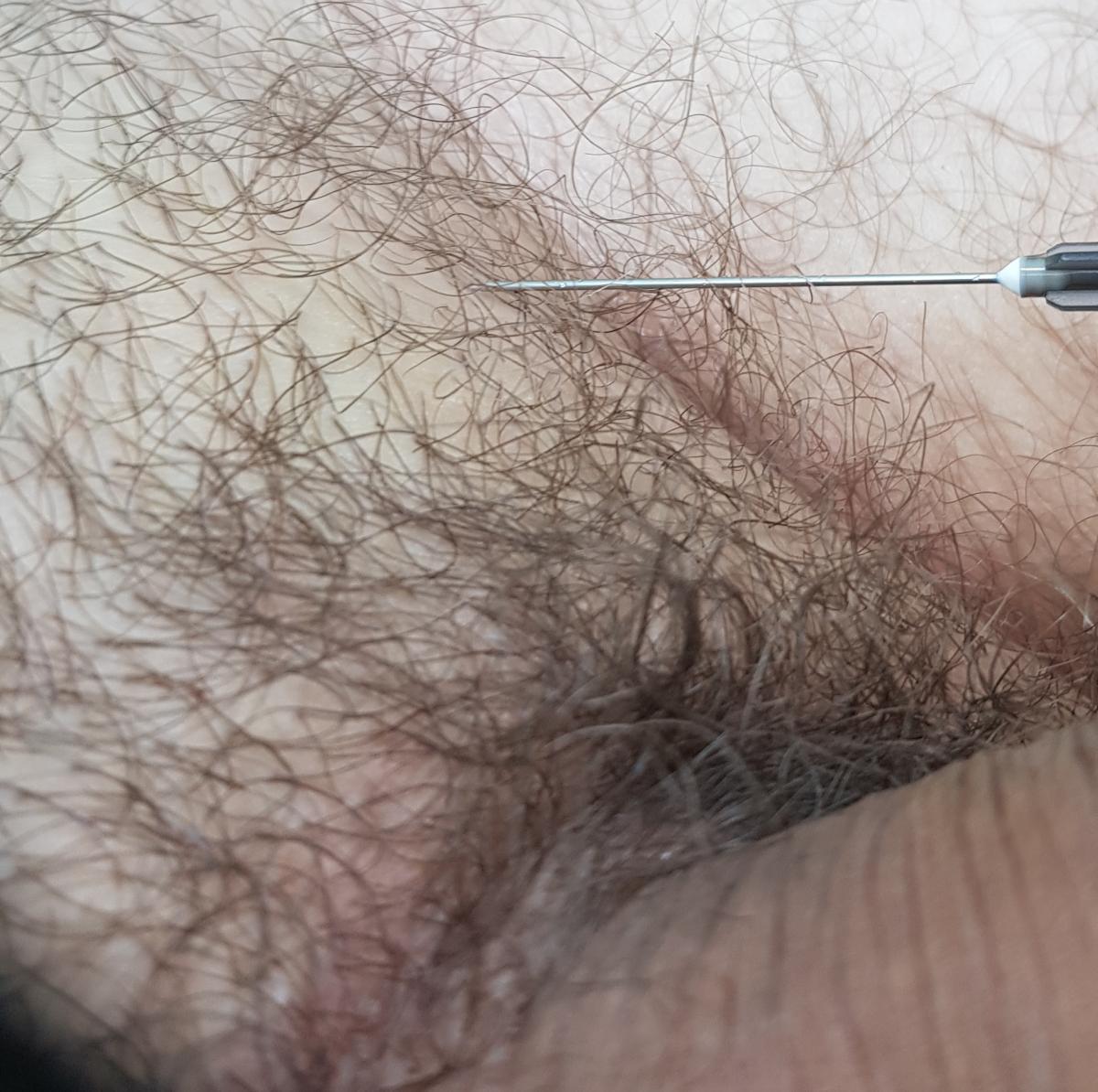 Лимфотропная инЪекция Лимфотропное введение иммуностимулирующих препаратов