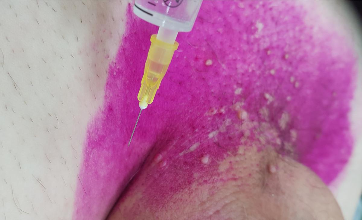 укол от сифилиса лечение сифилиса