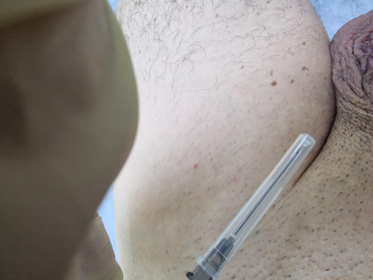 лимфотропная терапия при боли и воспалении в левом яичке лимфотропная терапия