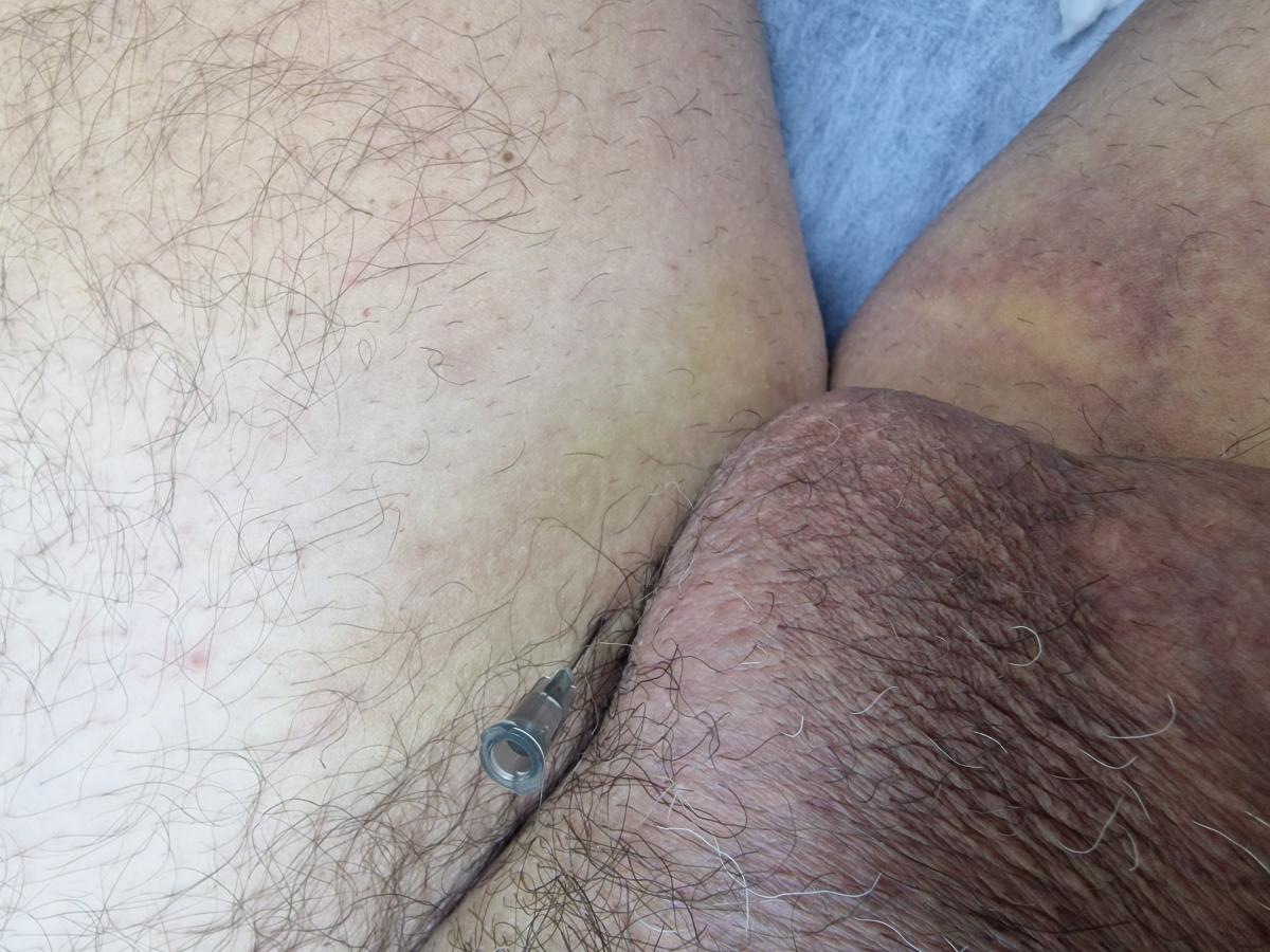 лимфотропка