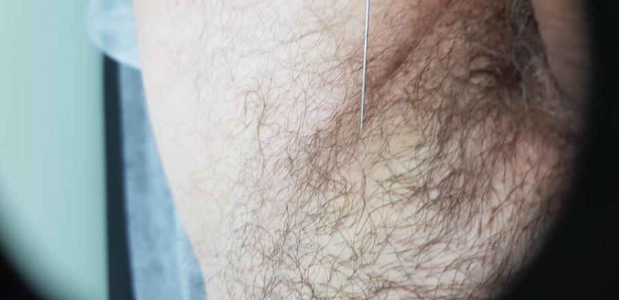 лимфотропное лечение колликулит