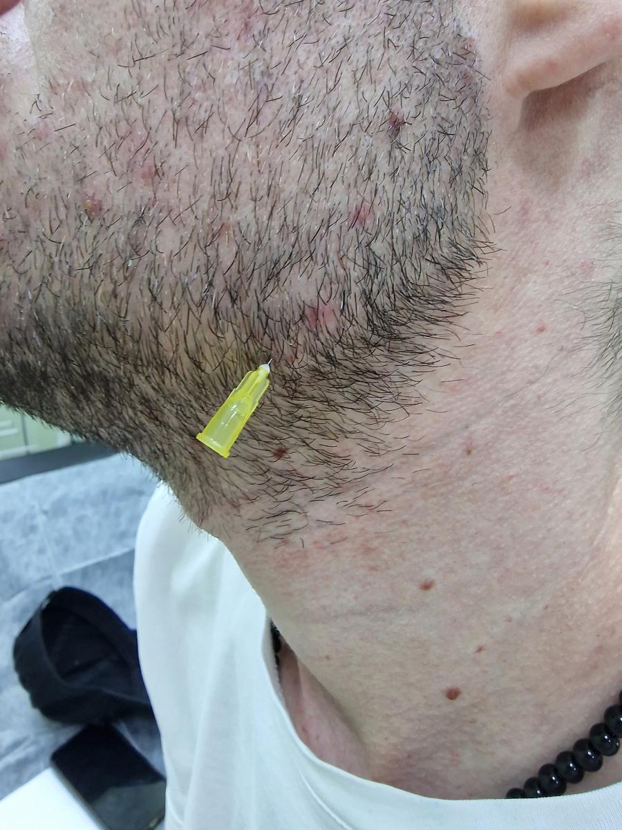 лимфотропная терапия лимфотропно