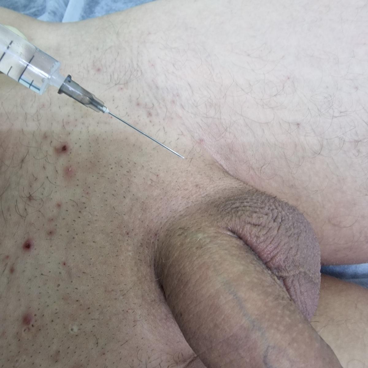 лимфотропное введение антибиотиков