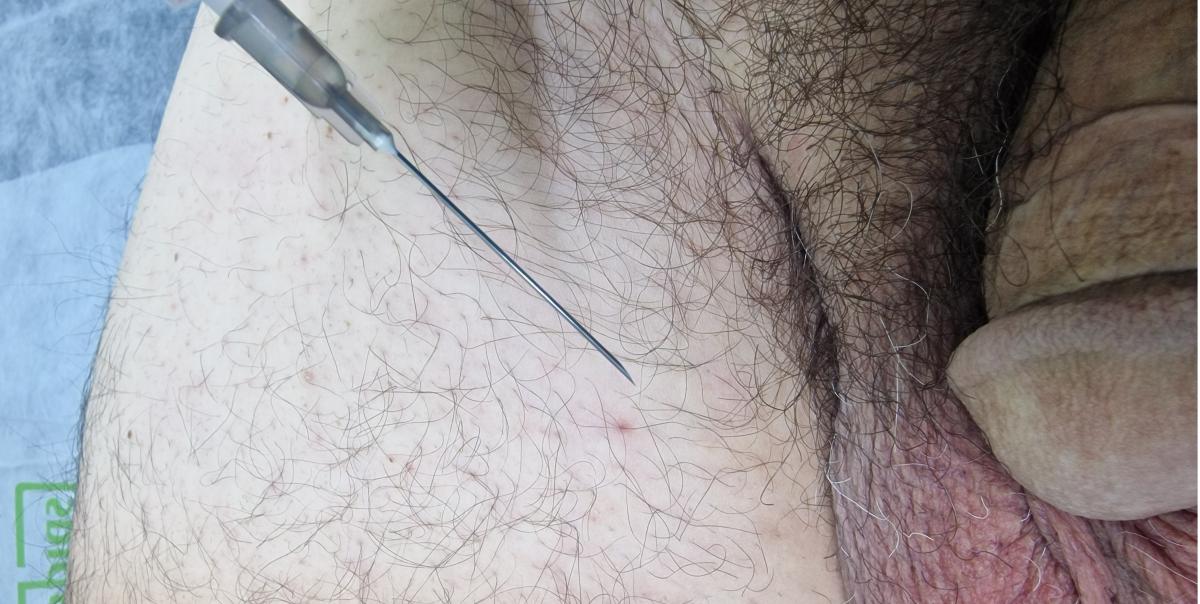 лимфотропная терапия антибиотики