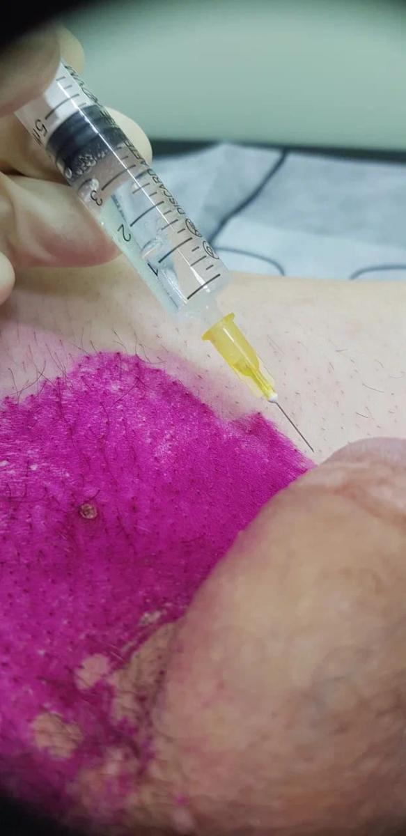 лимфотропное введение антибиотиков лимфотропное введение антибиотиков