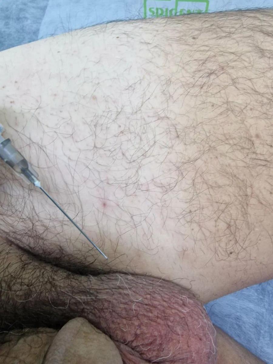 Лимфотропное введение