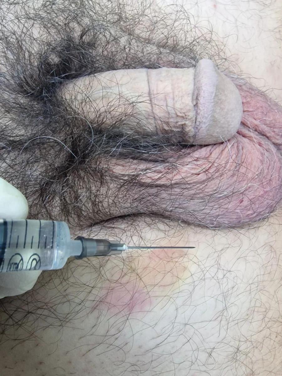 Лимфотропное введение