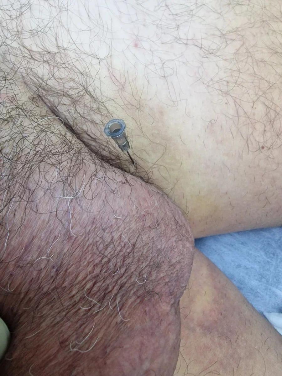 Лимфотропное введение
