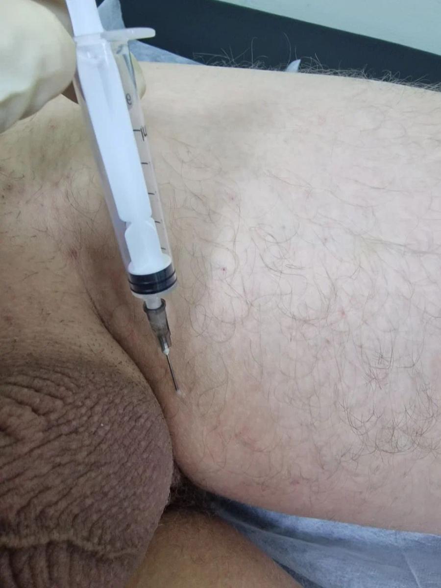 лимфотропное введение противогрибковых препаратов