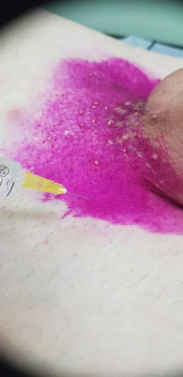 Лимфотропное введение