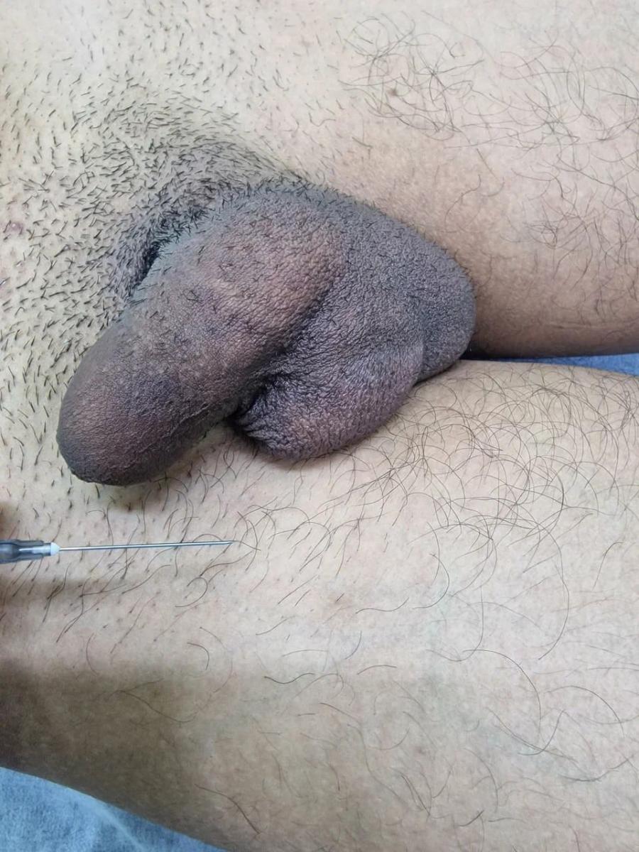 Лимфотропное введение Лимфотропное введение