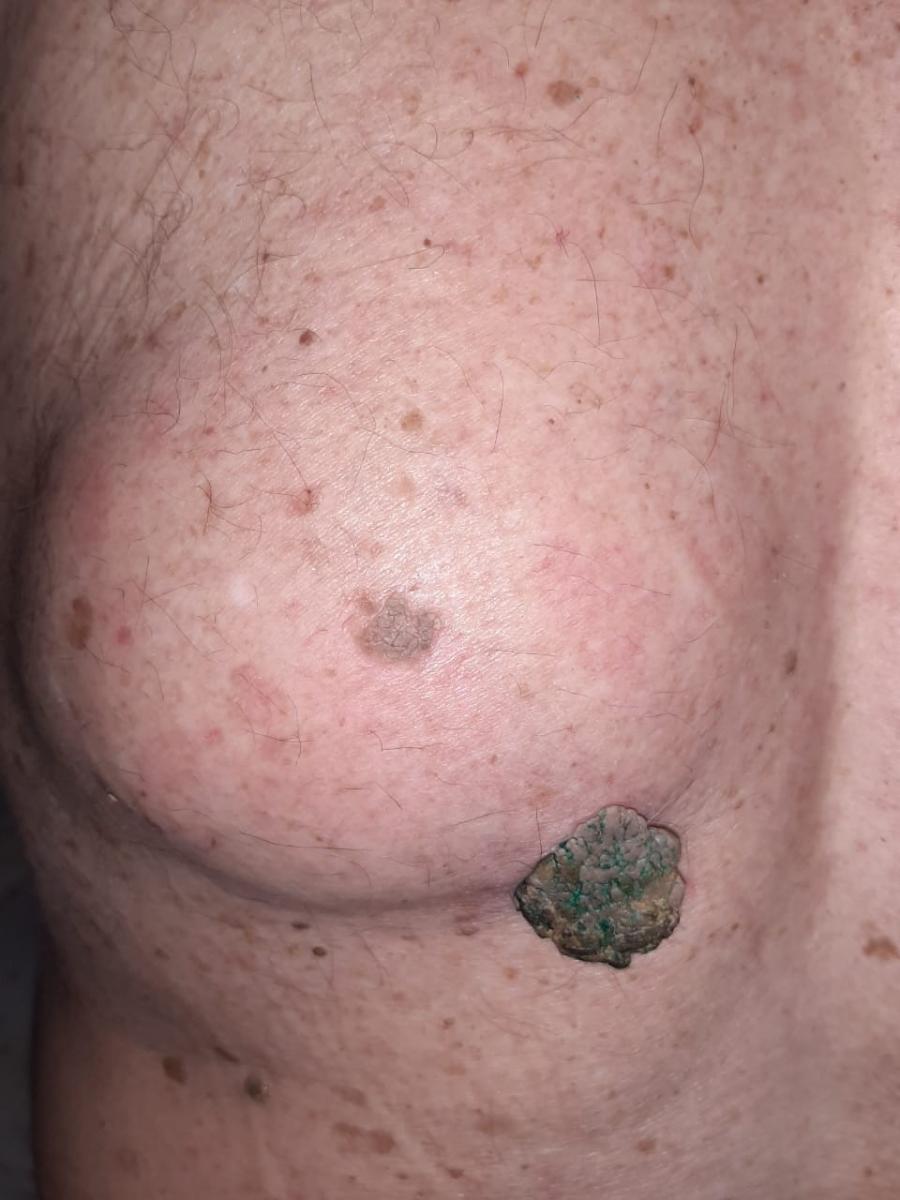 липома и кератома в области позвоночника липома у мужчины